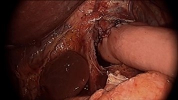 胃癌に対する腹腔鏡下胃全摘術