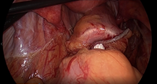 胃癌に対する腹腔鏡下幽門側胃切除術