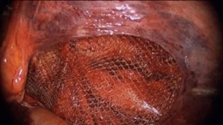 鼠径ヘルニアに対する腹腔鏡手術（TAPP法）