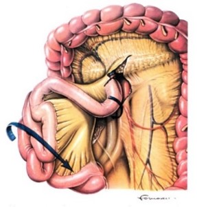 腸回転解除法の図
