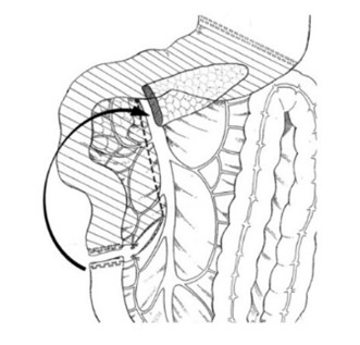 鼠腸回転解除法の図