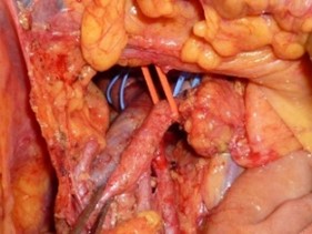 上腸間膜動静脈のテーピング